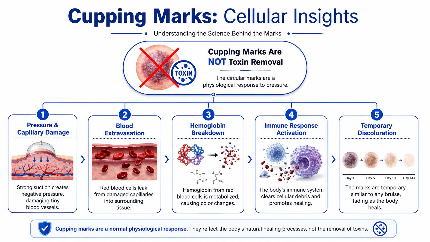 A diagram explaining that cupping marks are caused by capillary damage, not toxin removal from the body.