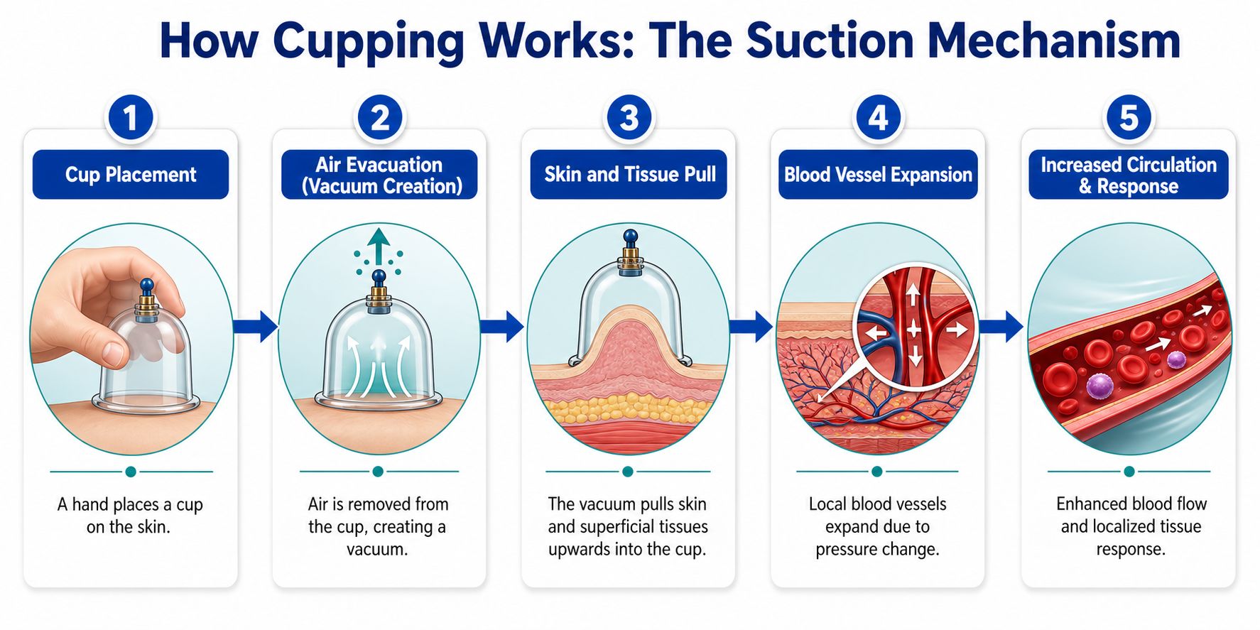 A five-step infographic showing how a suction cup is applied to skin to increase local blood circulation.