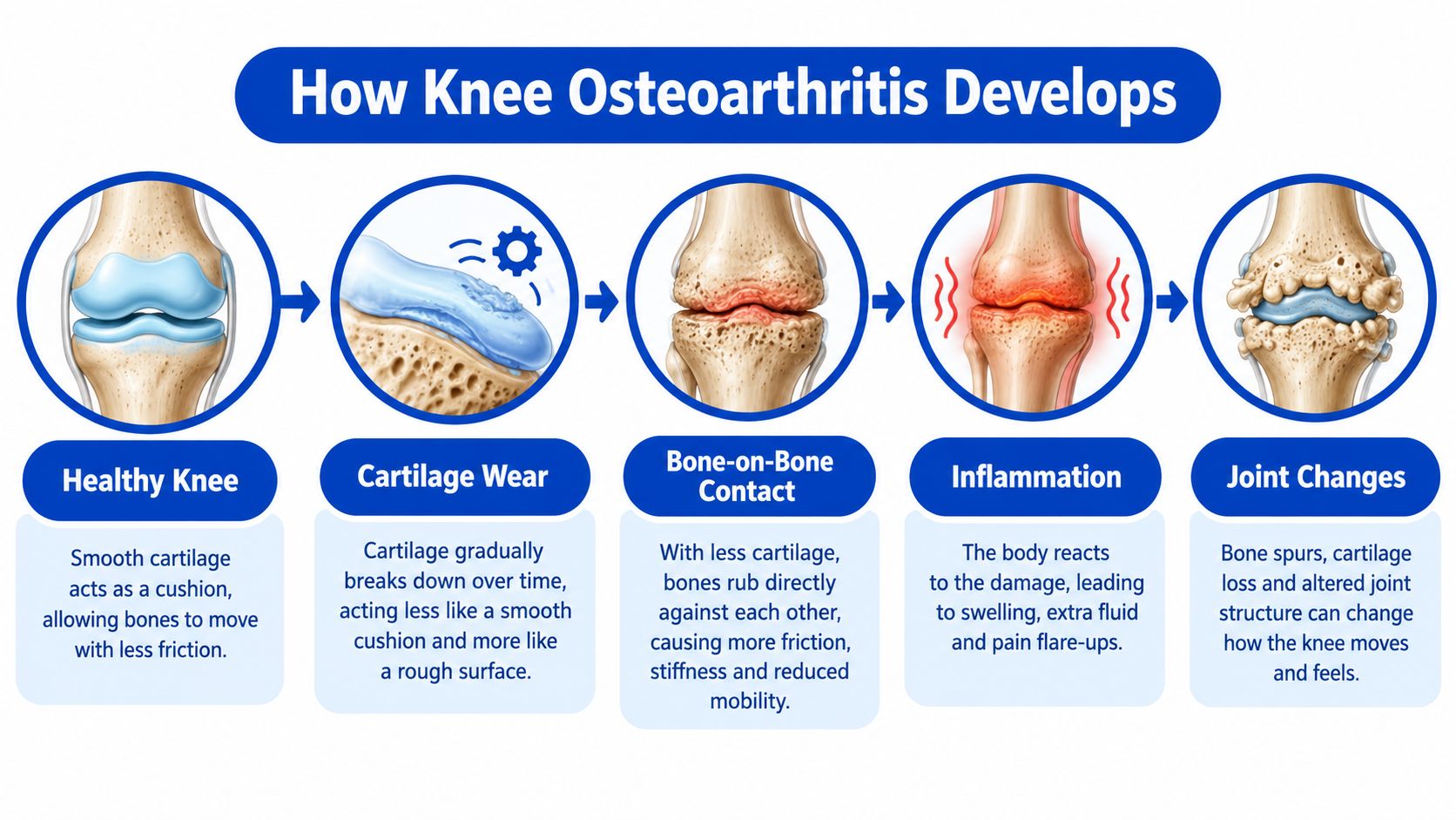 An infographic illustrating the progressive stages of knee osteoarthritis development, from healthy cartilage to structural joint changes.